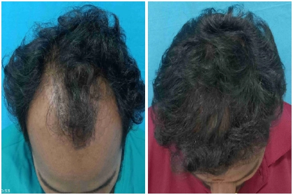 Hair Transplant Treatment